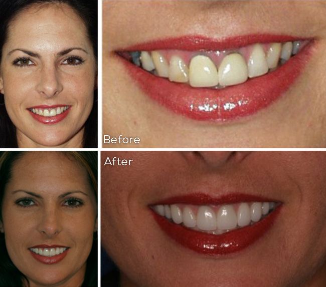 before and after dental procedure