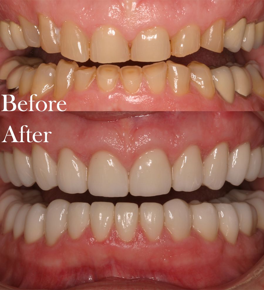 before and after dental procedure