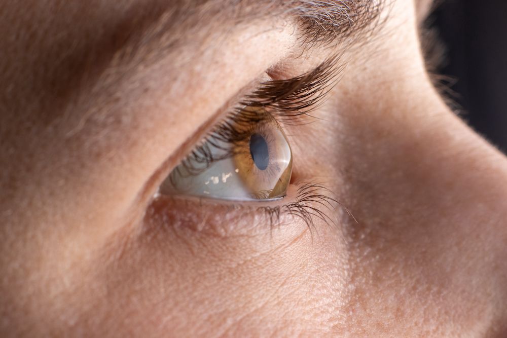 What is Keratoconus, and What are the Causes and Symptoms?