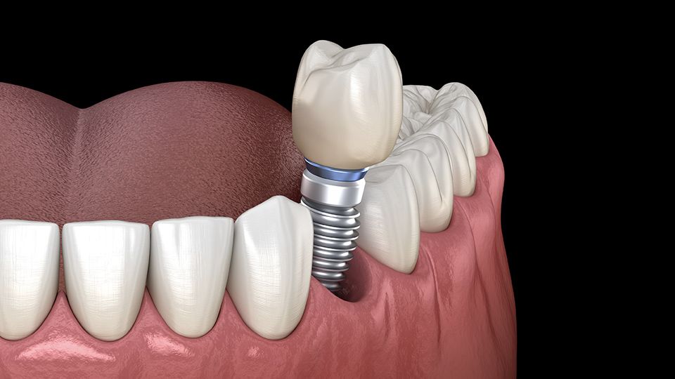 Dental Implants