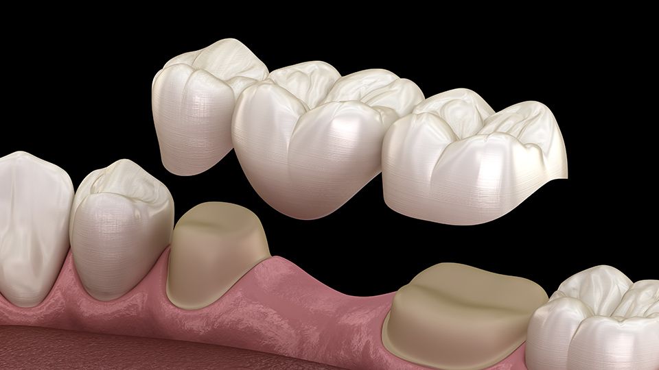 Ceramic Crowns and Bridges