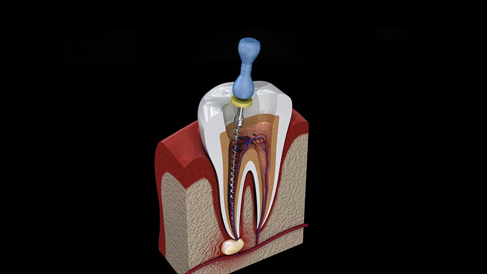 Root Canals