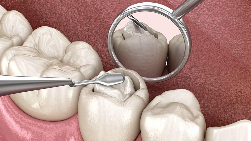 Composite Resin Fillings