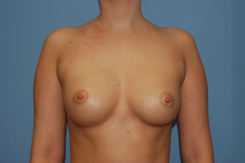 After Breast Augmentation with Fat Grafting by Dr. Bermudez