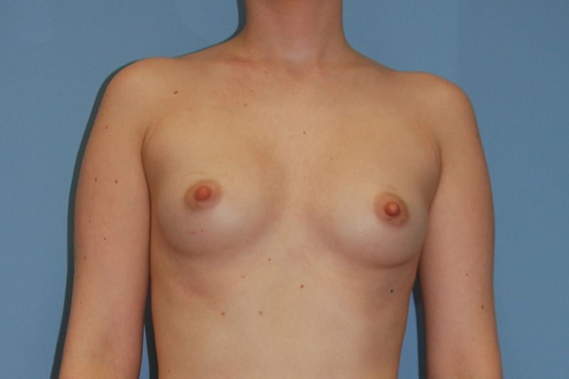 Before Breast Augmentation with Fat Grafting by Dr. Bermudez