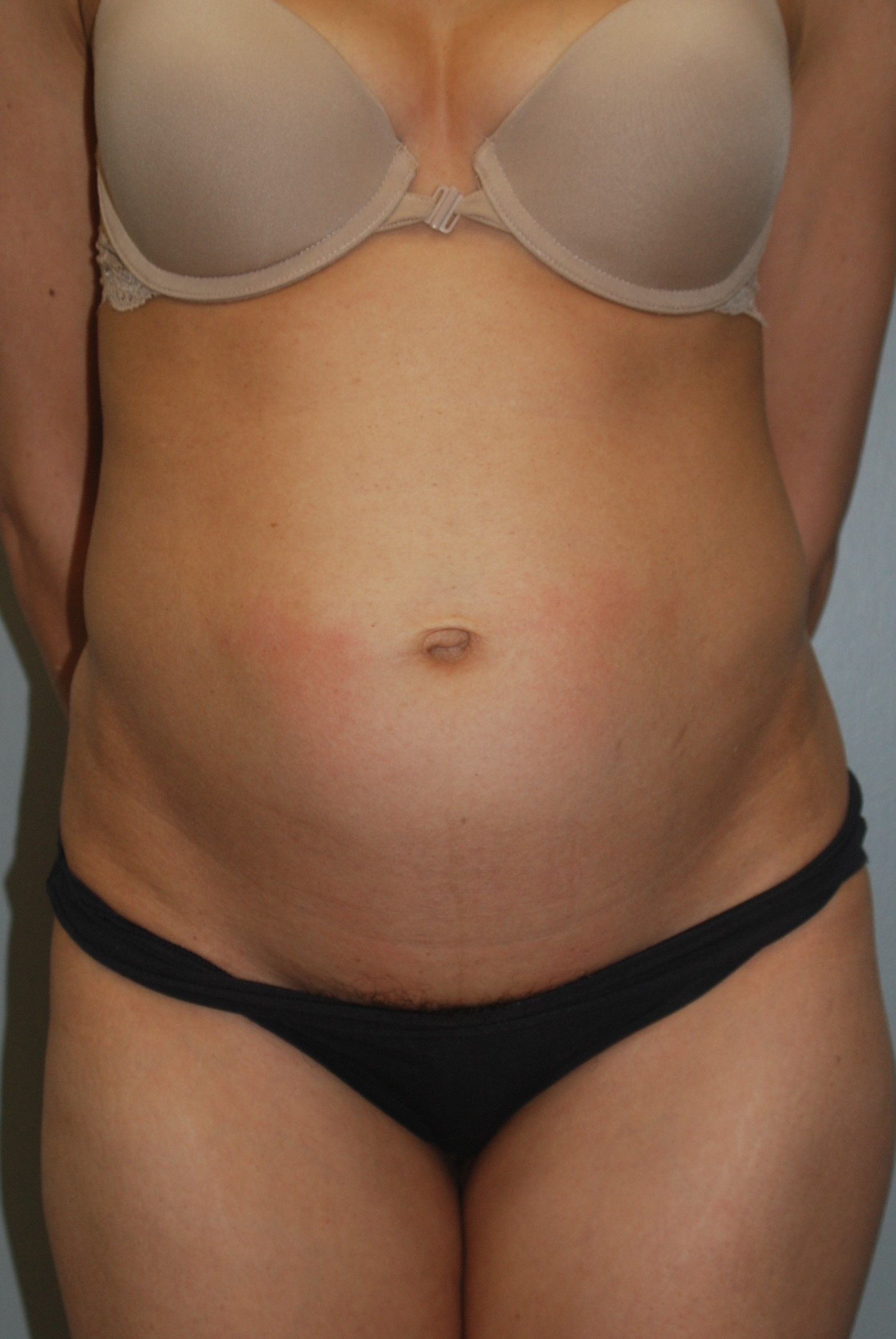 Before Abdominoplasty