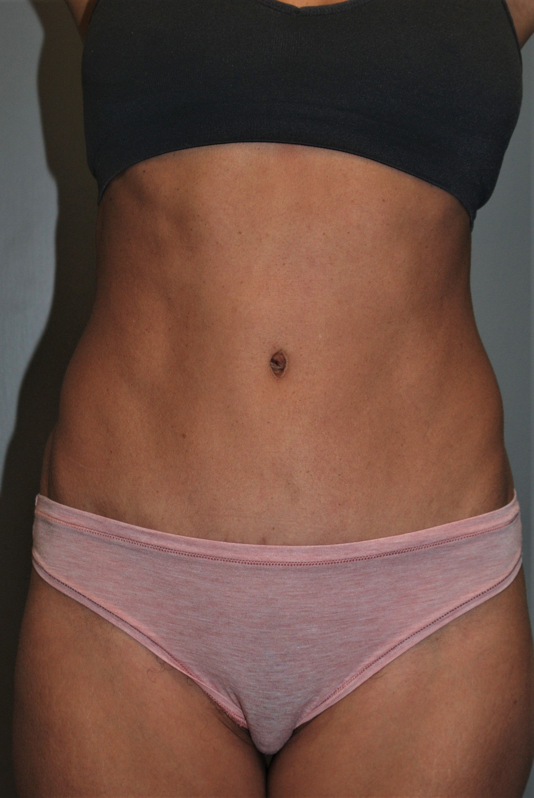 After Abdominoplasty