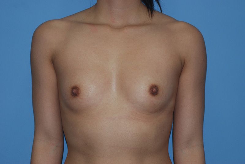 Before Breast Augmentation with Fat Grafting by Dr. Bermudez