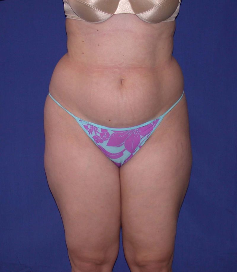 Before Tummy Tuck Surgery by Dr. Bermudez in San Francisco