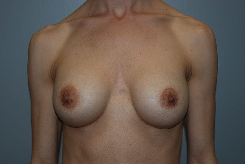 After Breast Augmentation with Breast Implants by Dr. Bermudez