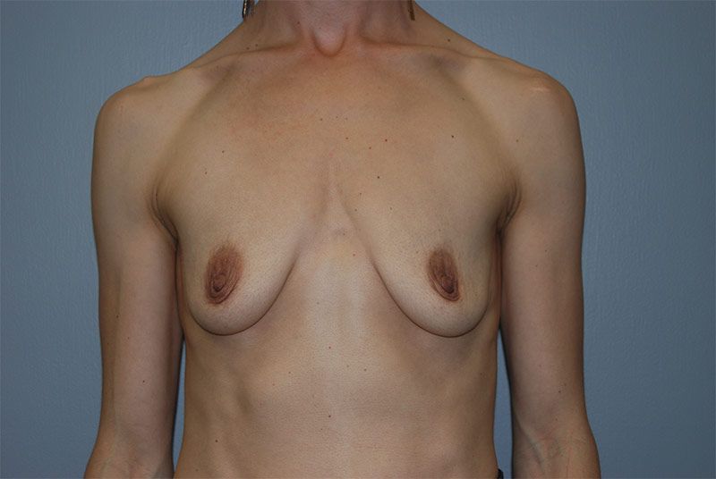 Before Breast Augmentation with Breast Implants by Dr. Bermudez