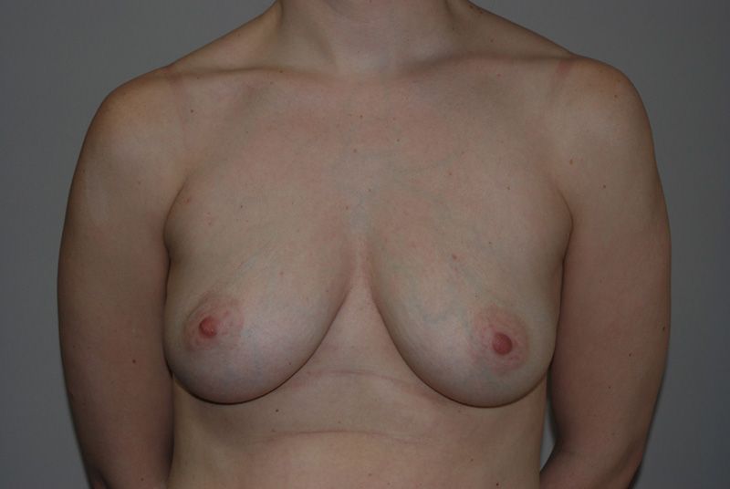 After Breast Augmentation with Fat Grafting by Dr. Bermudez