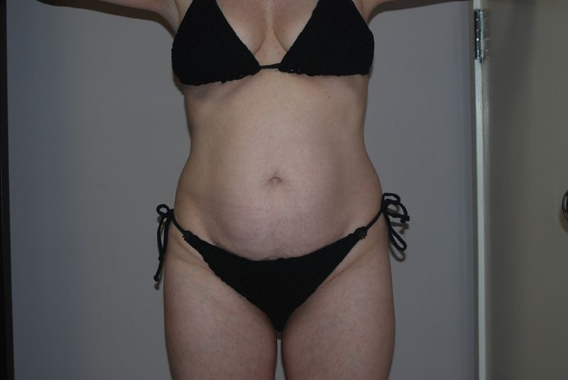 before tummy tuck