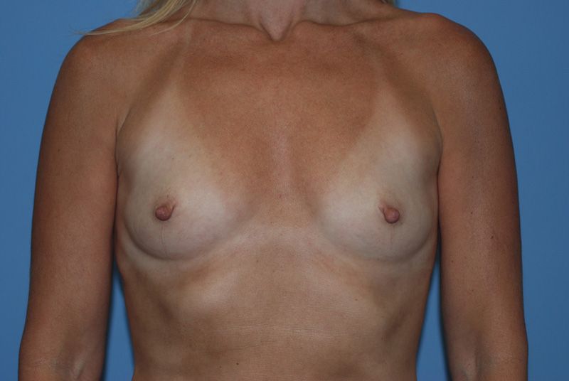 Before Breast Augmentation with Breast Implants by Dr. Bermudez