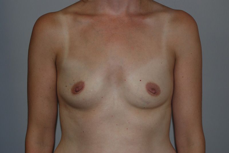 Before Breast Augmentation with Fat Grafting by Dr. Bermudez