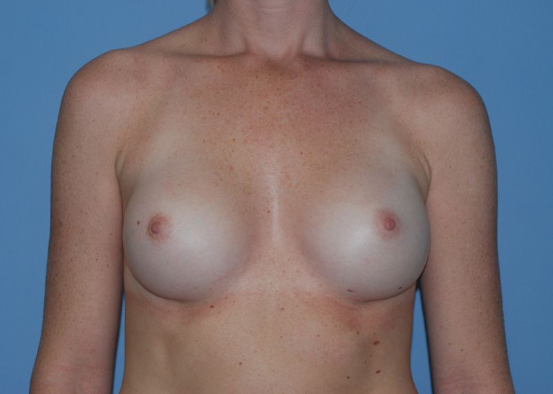 After Breast Augmentation with Breast Implants by Dr. Bermudez