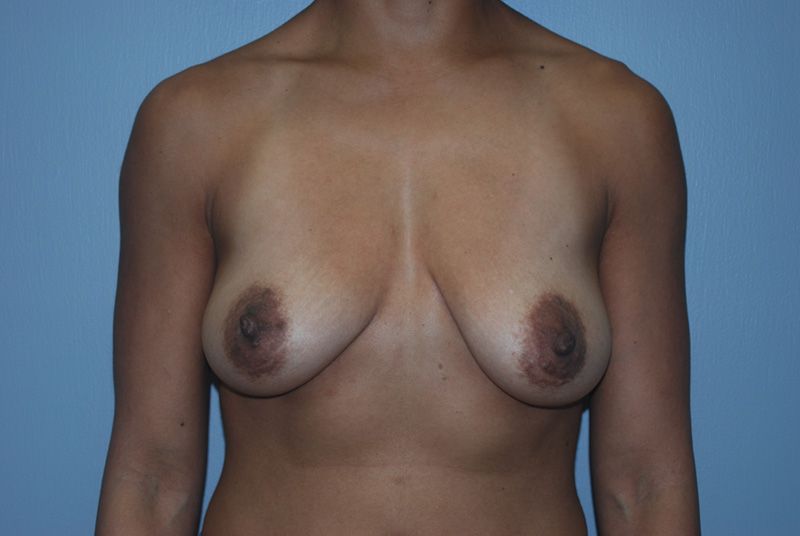 Before Breast Lift with Fat Grafting by Dr. Bermudez in San Francisco