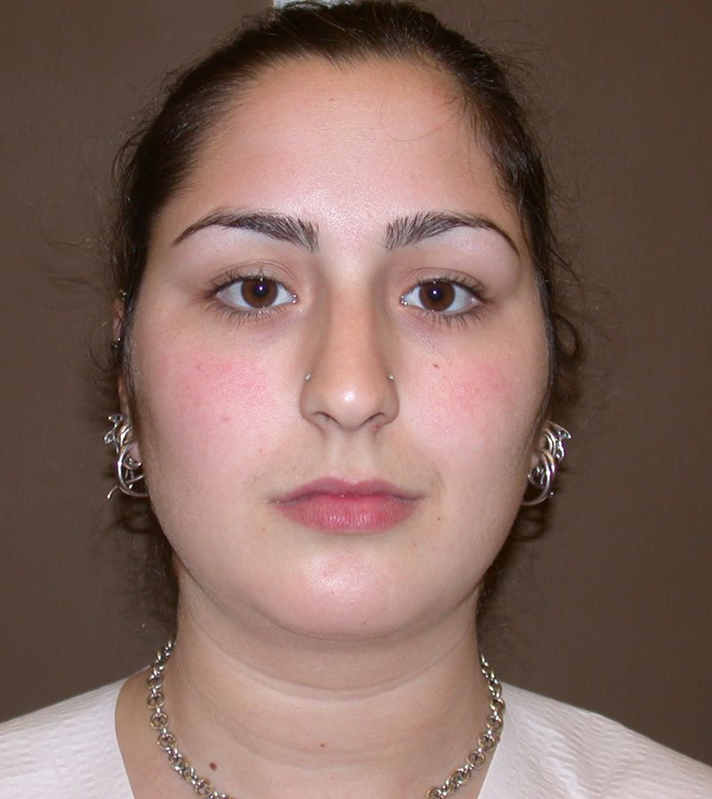 Before Nose Job Surgery by Dr. Bermudez in San Francisco