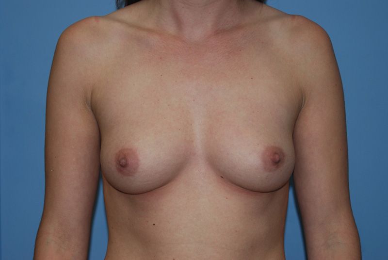 Before Breast Augmentation with Breast Implants by Dr. Bermudez