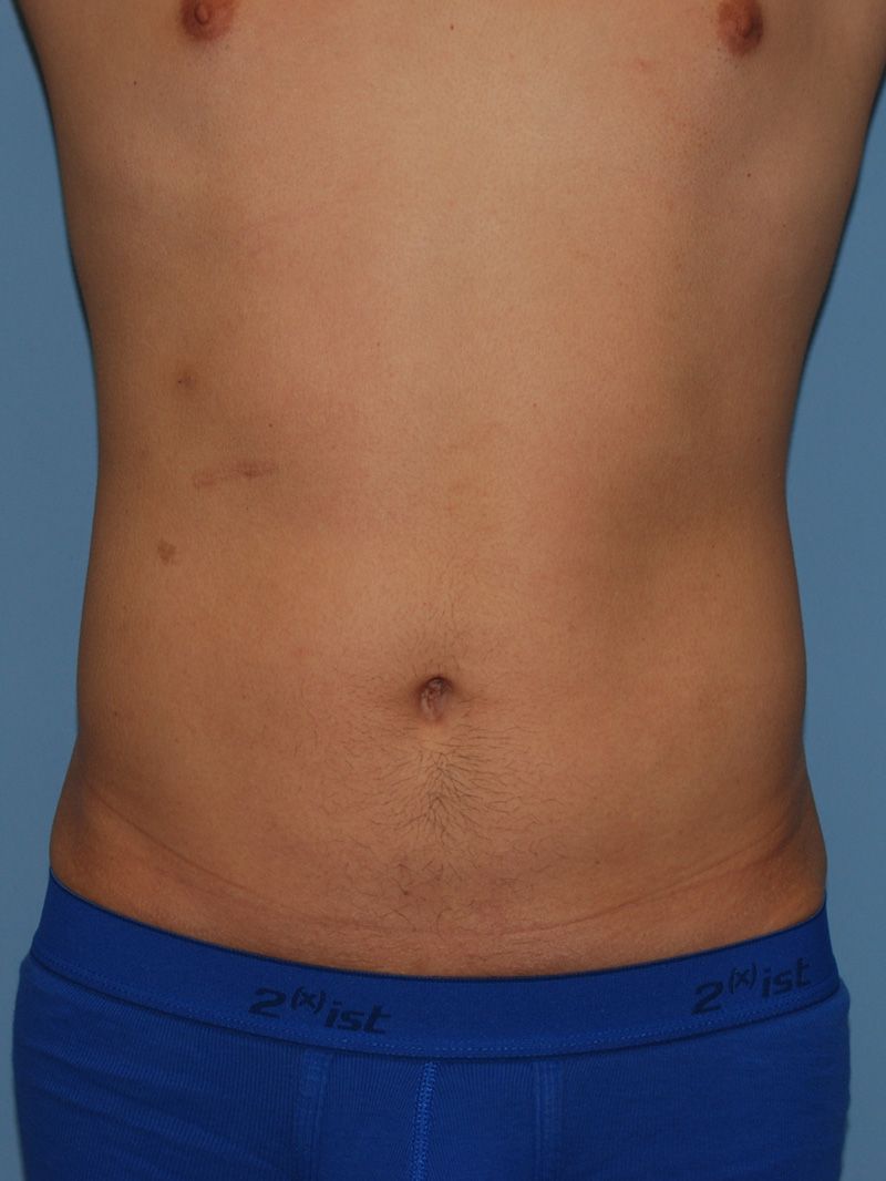 After Liposuction by Dr. Bermudez