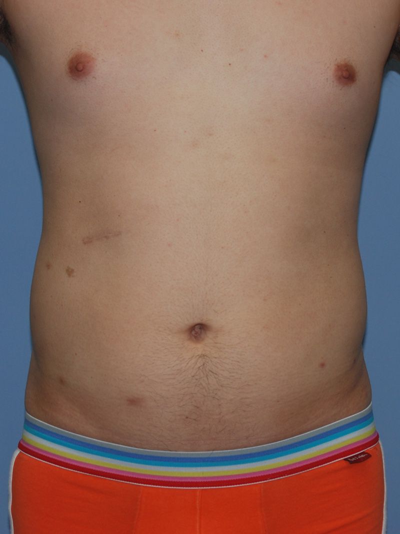 Before Liposuction by Dr. Bermudez