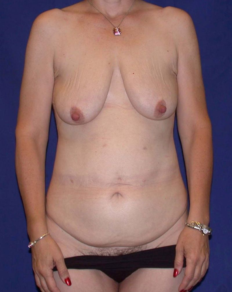 Before Abdominoplasty