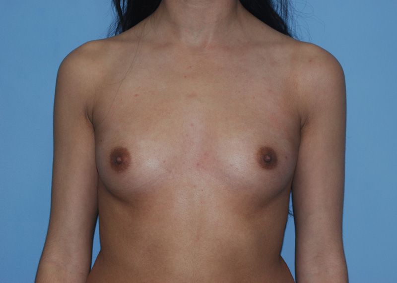 Before Breast Augmentation with Breast Implants by Dr. Bermudez