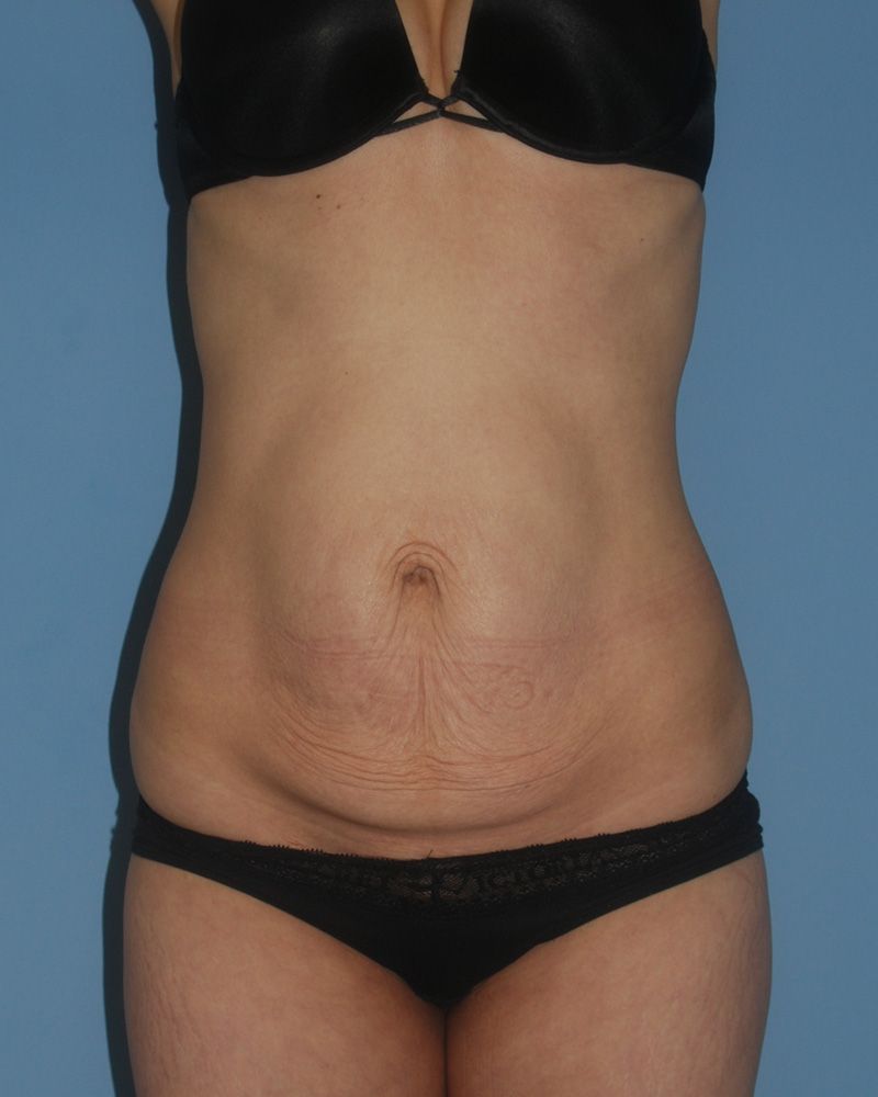 Before Abdominoplasty by Dr. Bermudez