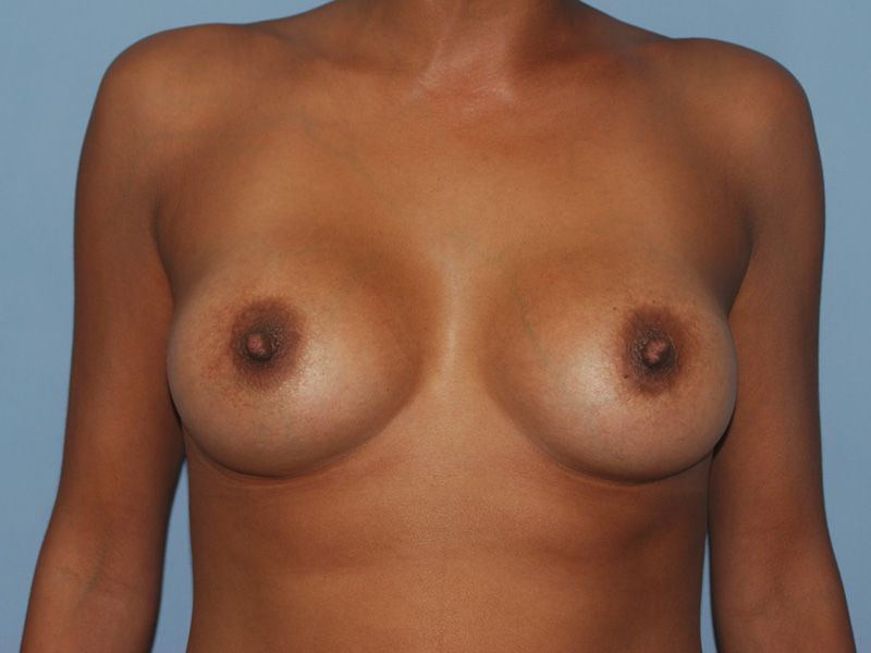 after breast implants