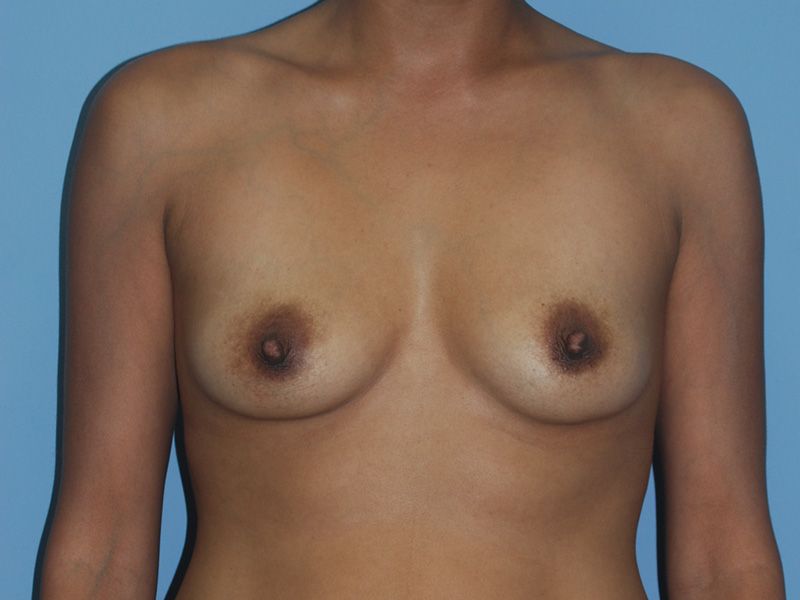 before breast implants