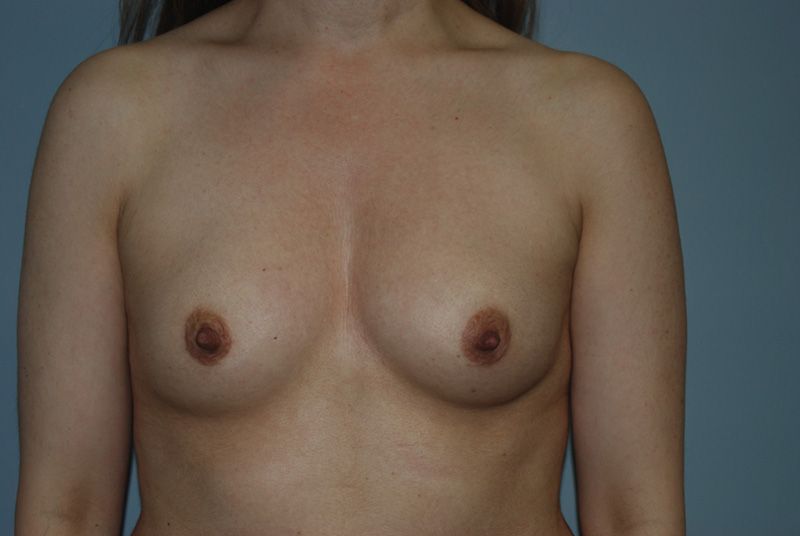 Before Breast Augmentation with Breast Implants by Dr. Bermudez