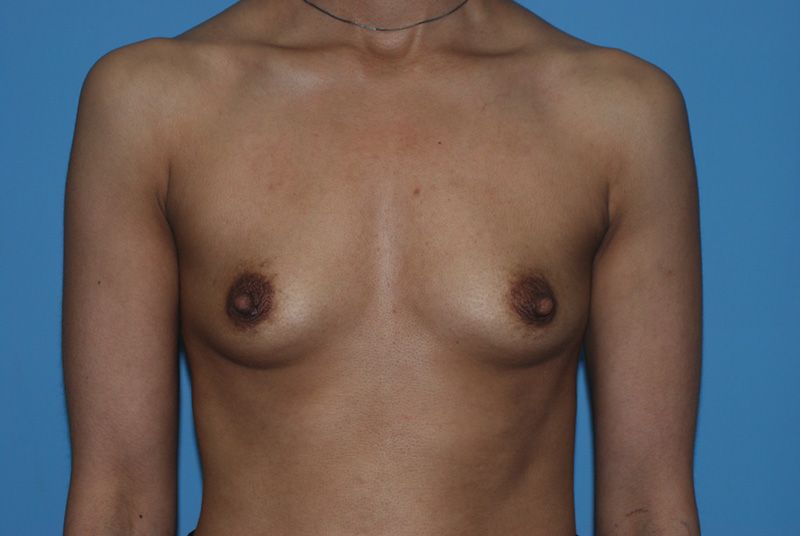 Before Breast Augmentation with Breast Implants by Dr. Bermudez