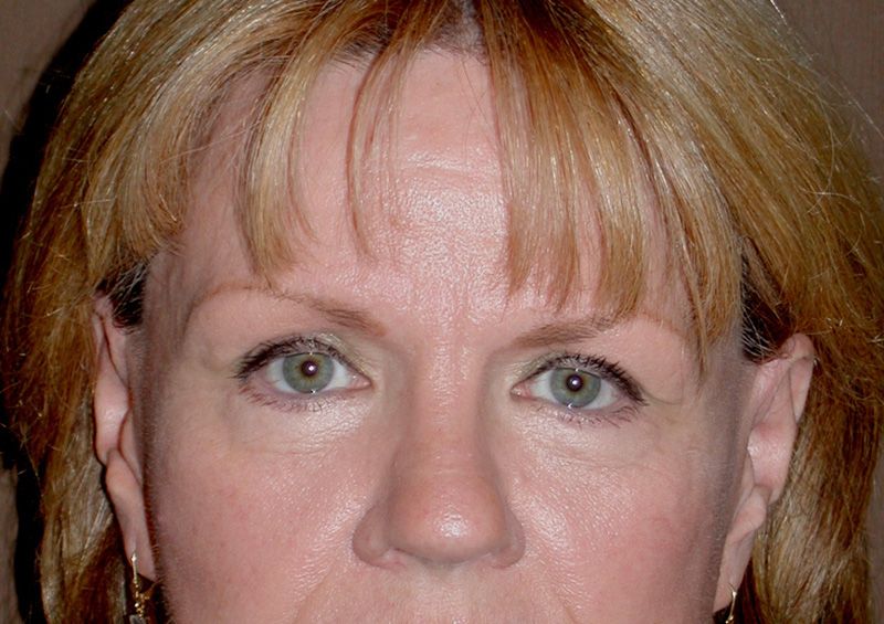 blepharoplasty after photos