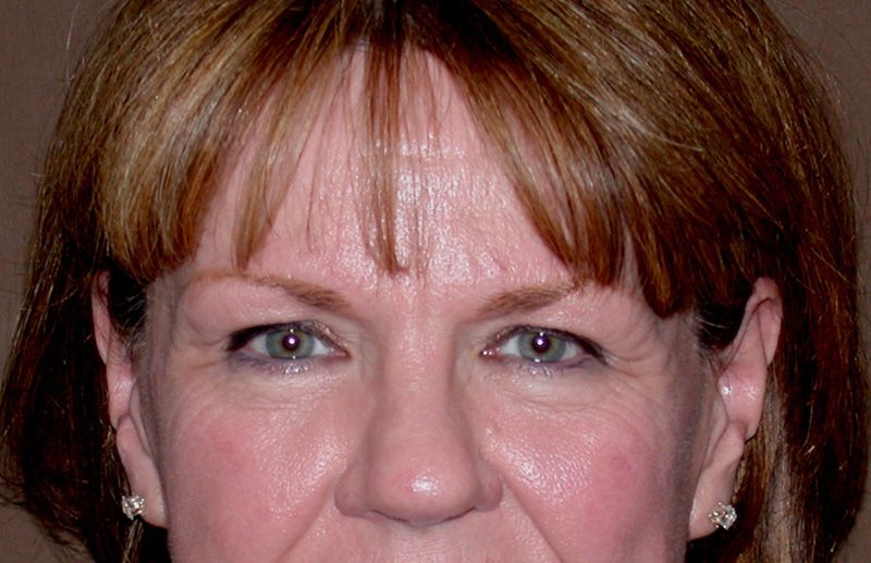 blepharoplasty before & after photos