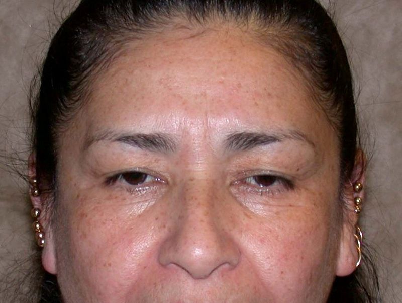 blepharoplasty before