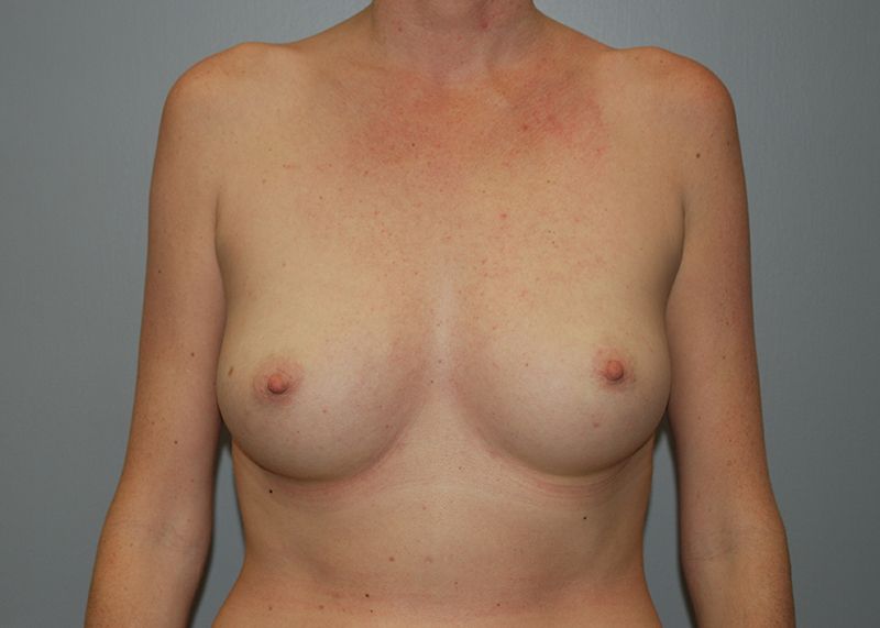 After Breast Augmentation with Fat Grafting by Dr. Bermudez