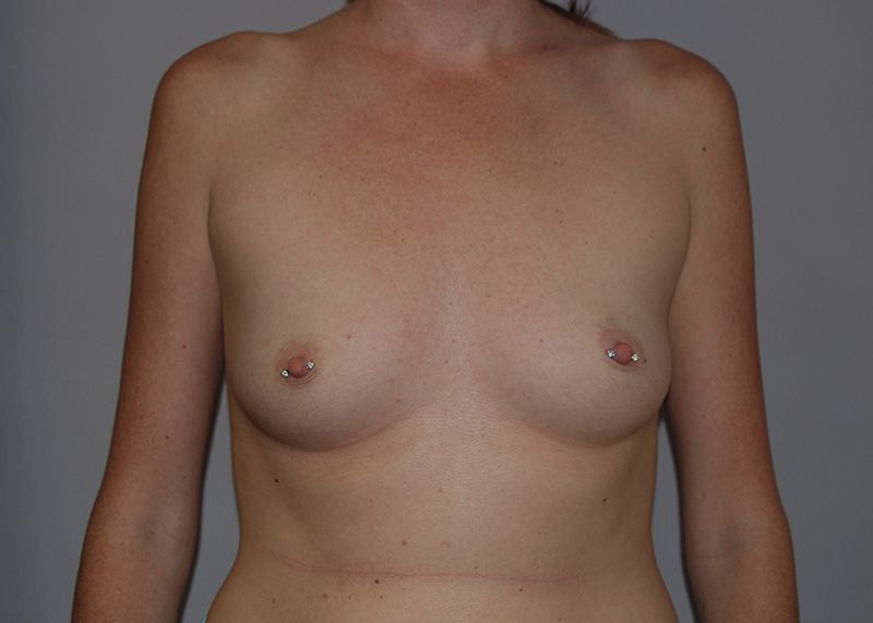 Before Breast Augmentation with Fat Grafting by Dr. Bermudez