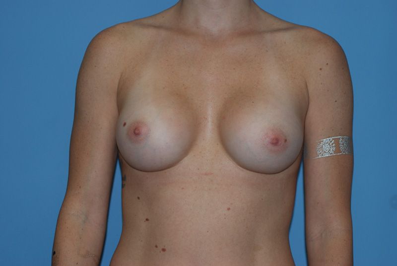 breast augmentation with breast implants after