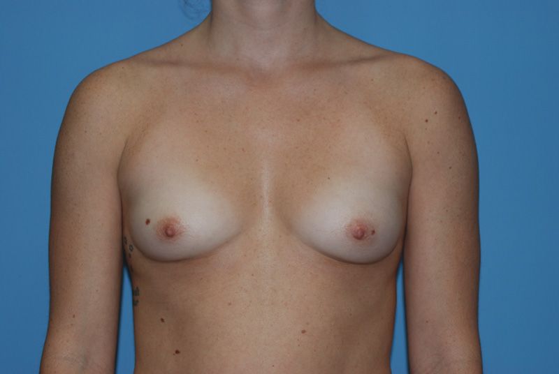 breast augmentation with breast implants before