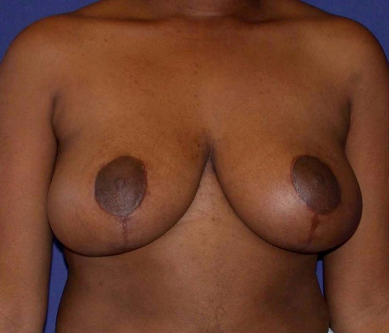 Breast Reduction After