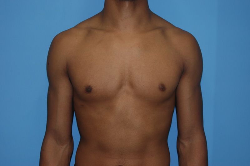 Male Breast Reduction - After