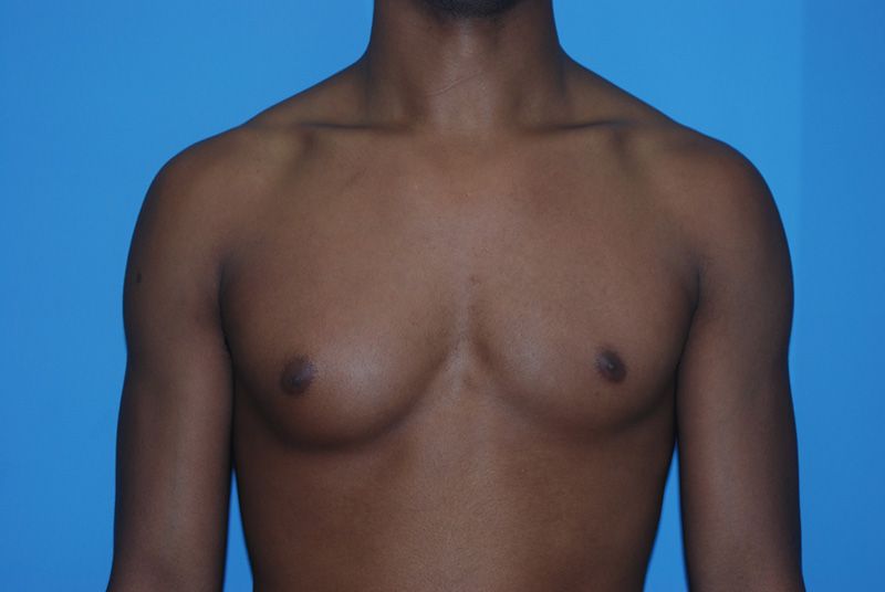 Male Breast Reduction - Before