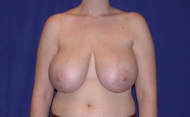 Breast Reduction - Before