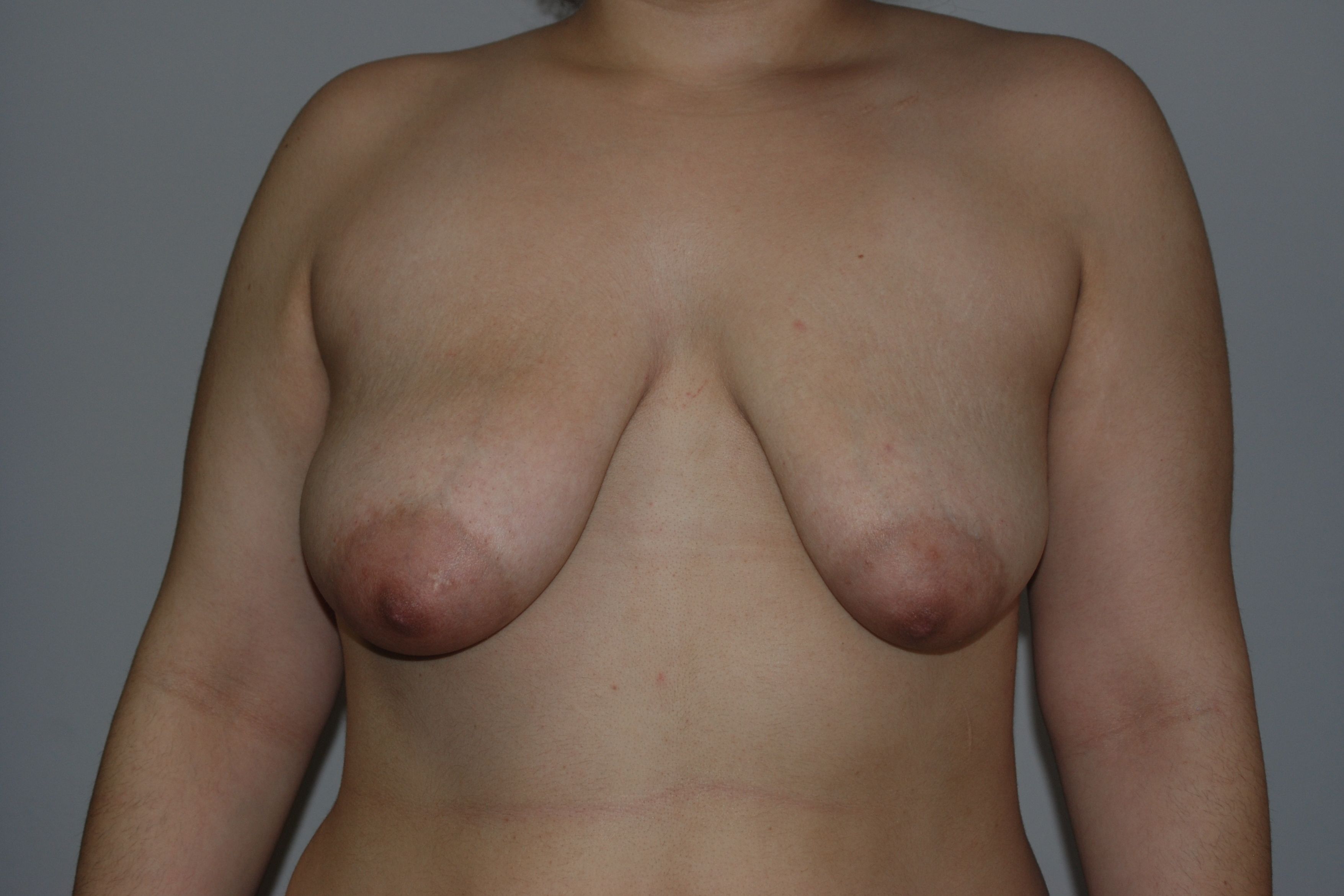 Before Breast Lift with Fat Grafting by Dr. Bermudez in San Francisco