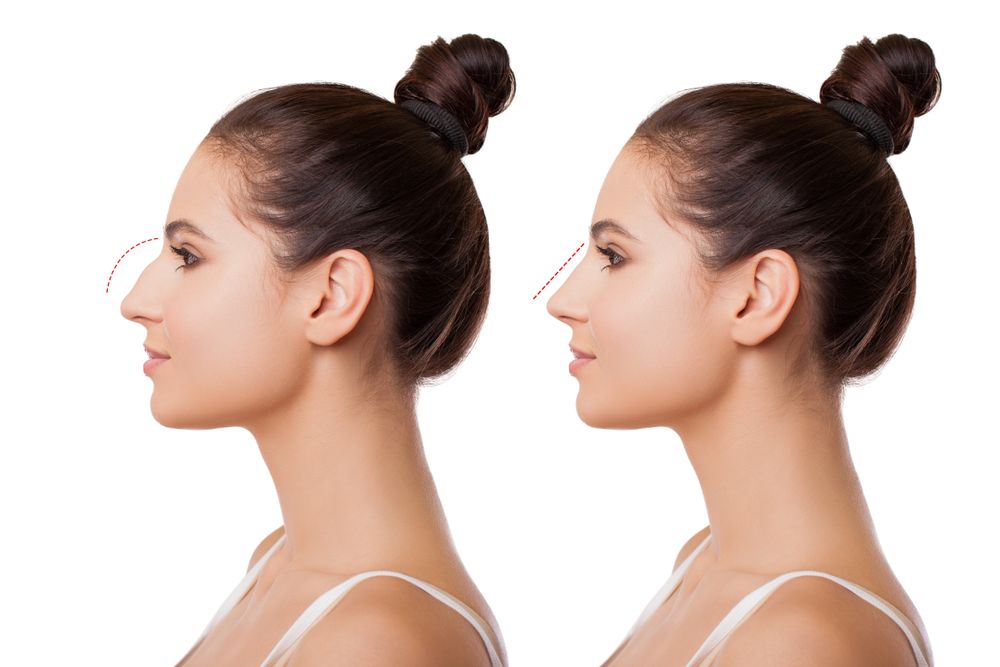 Rhinoplasty