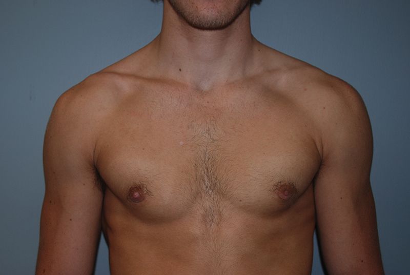 Male Breast Reduction - After