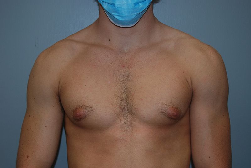 Male Breast Reduction - Before