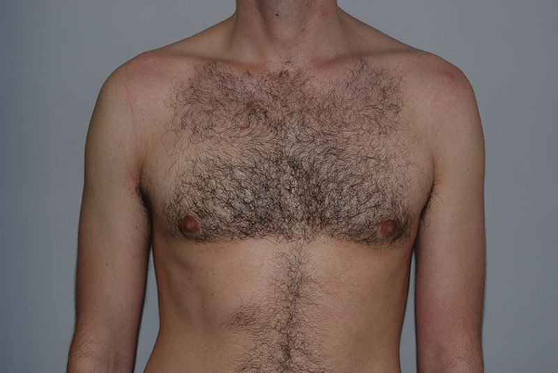 Male Breast Reduction - After