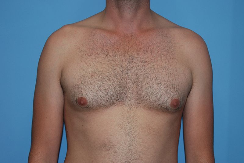 Male Breast Reduction - Before