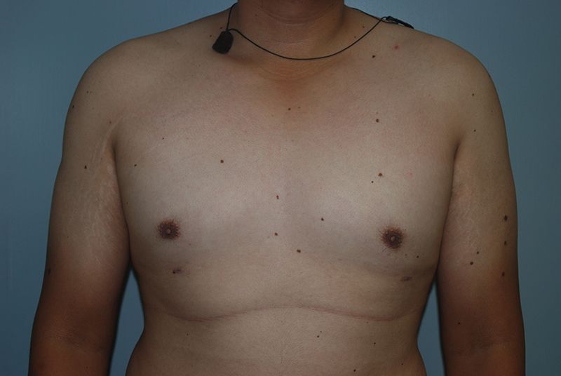 Male Breast Reduction - After